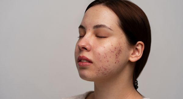 TRATAMIENTO ANTIACNÉ 🧼