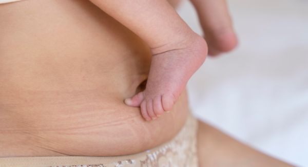 TRATAMIENTO PARA ESTRIAS